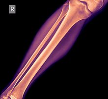 X-ray of the lower leg with a fractured tibia side view by PhotoStock-Isra