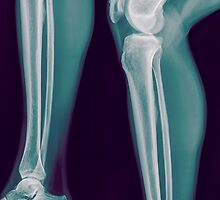 x-ray of the right knee of a 42 year old male by PhotoStock-Isra