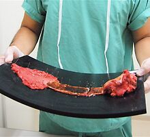 Cancer Surgery (12)、OSAKA JAPAN by yoshiaki nagashima